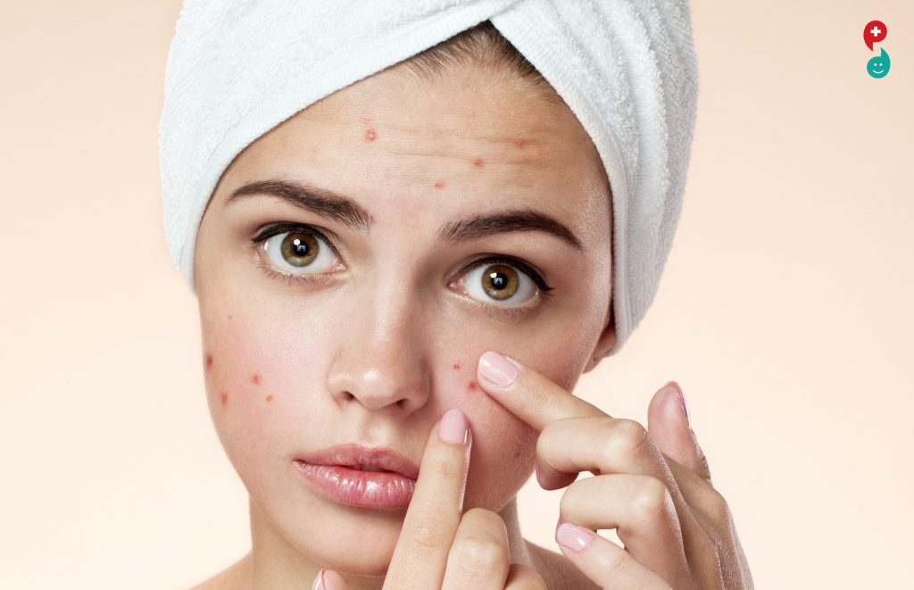 How To Clear Up Pimples From Face at Jeana Newman blog